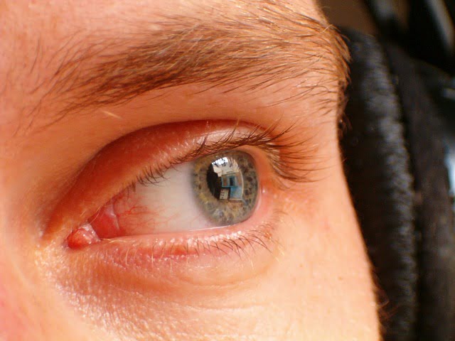 Coçar os Olhos com Frequência e Intensidade Pode Causar Ceratocone