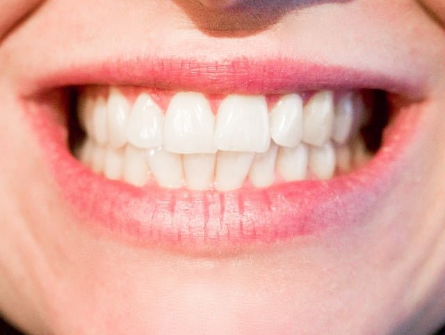 11 Mitos e Verdades sobre Clareamento Dental