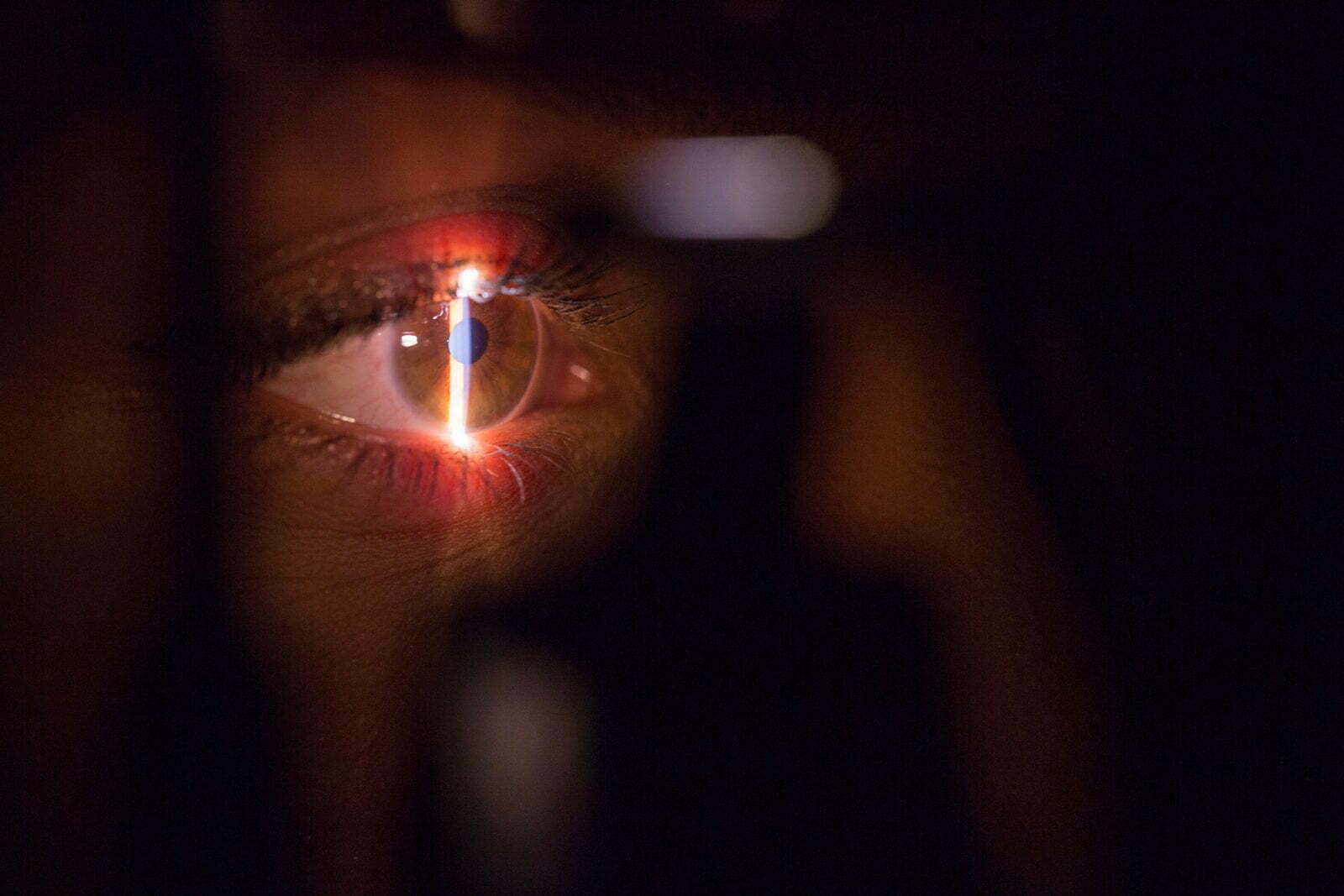 Metade das pessoas com herpes-zóster desenvolve sintomas oculares